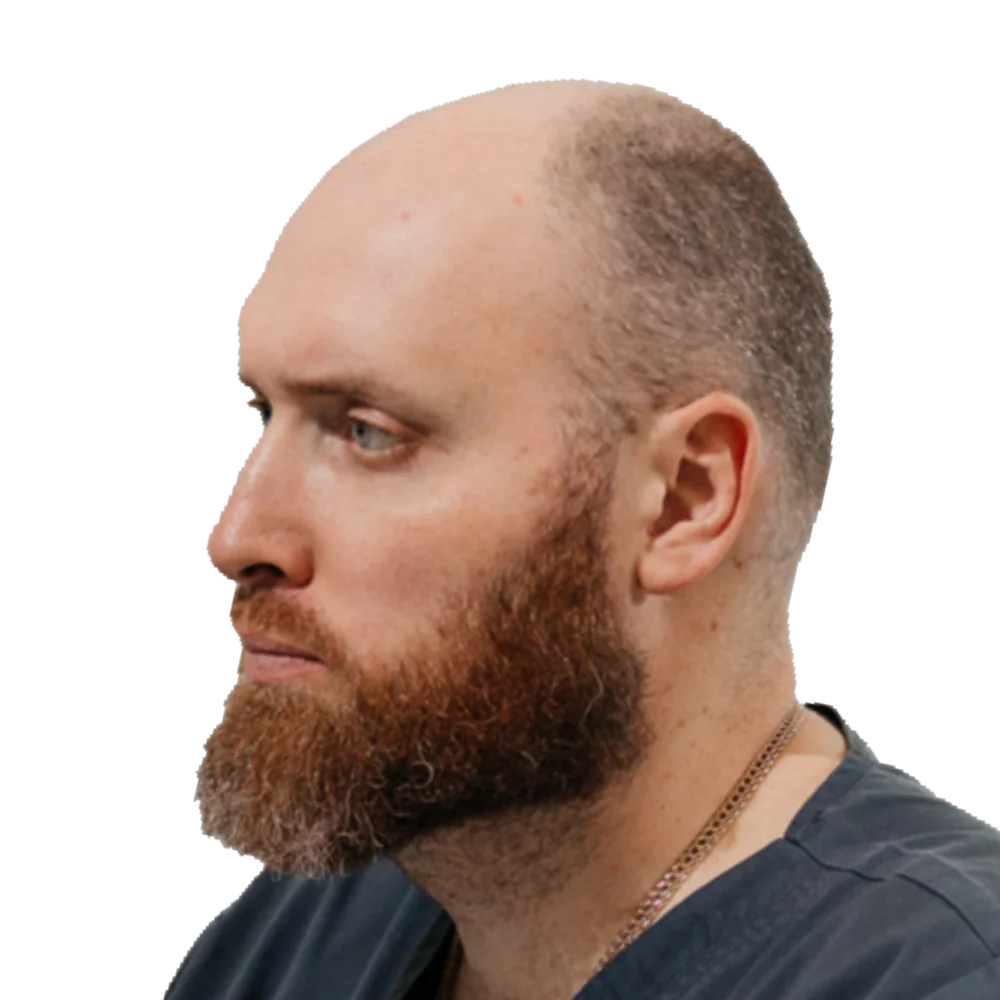 Пересадка бороды